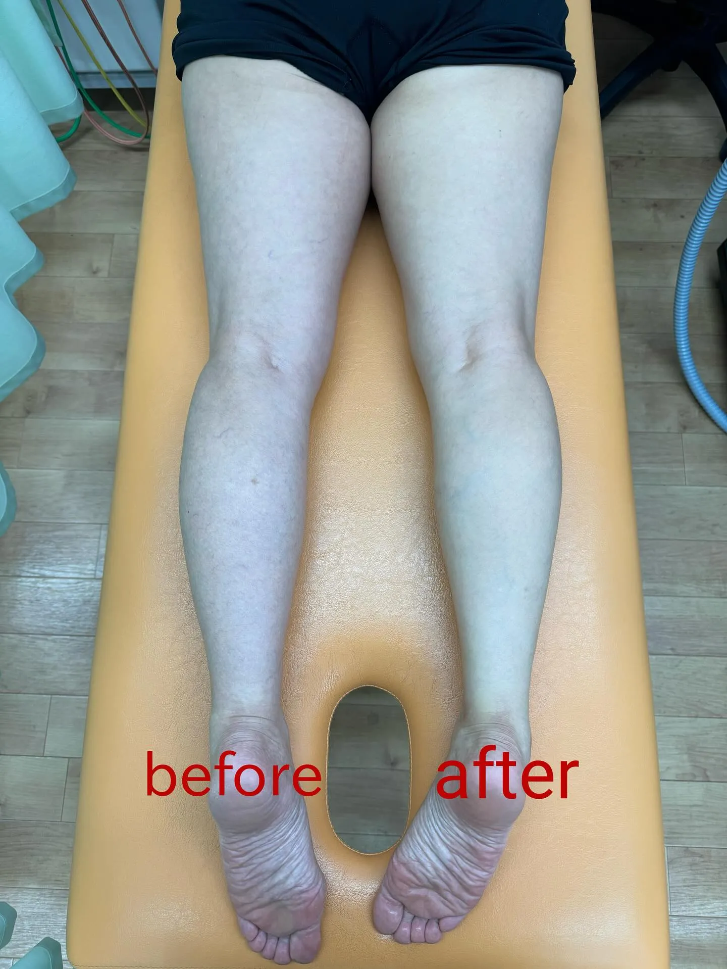 🦵【そのむくみ、実は“筋膜”が原因かも！？】