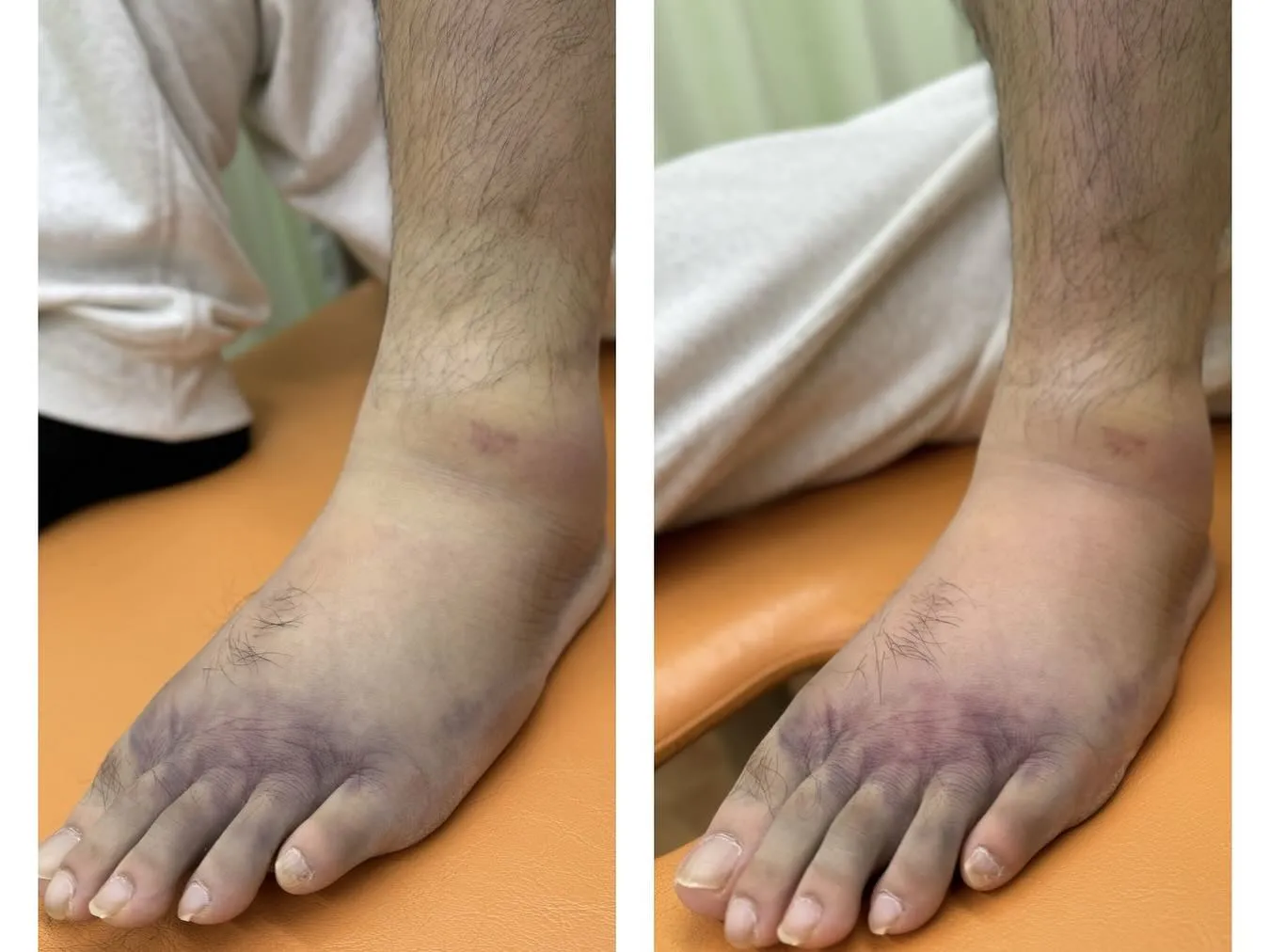 【スポーツ障害のケア🏃‍♂️】