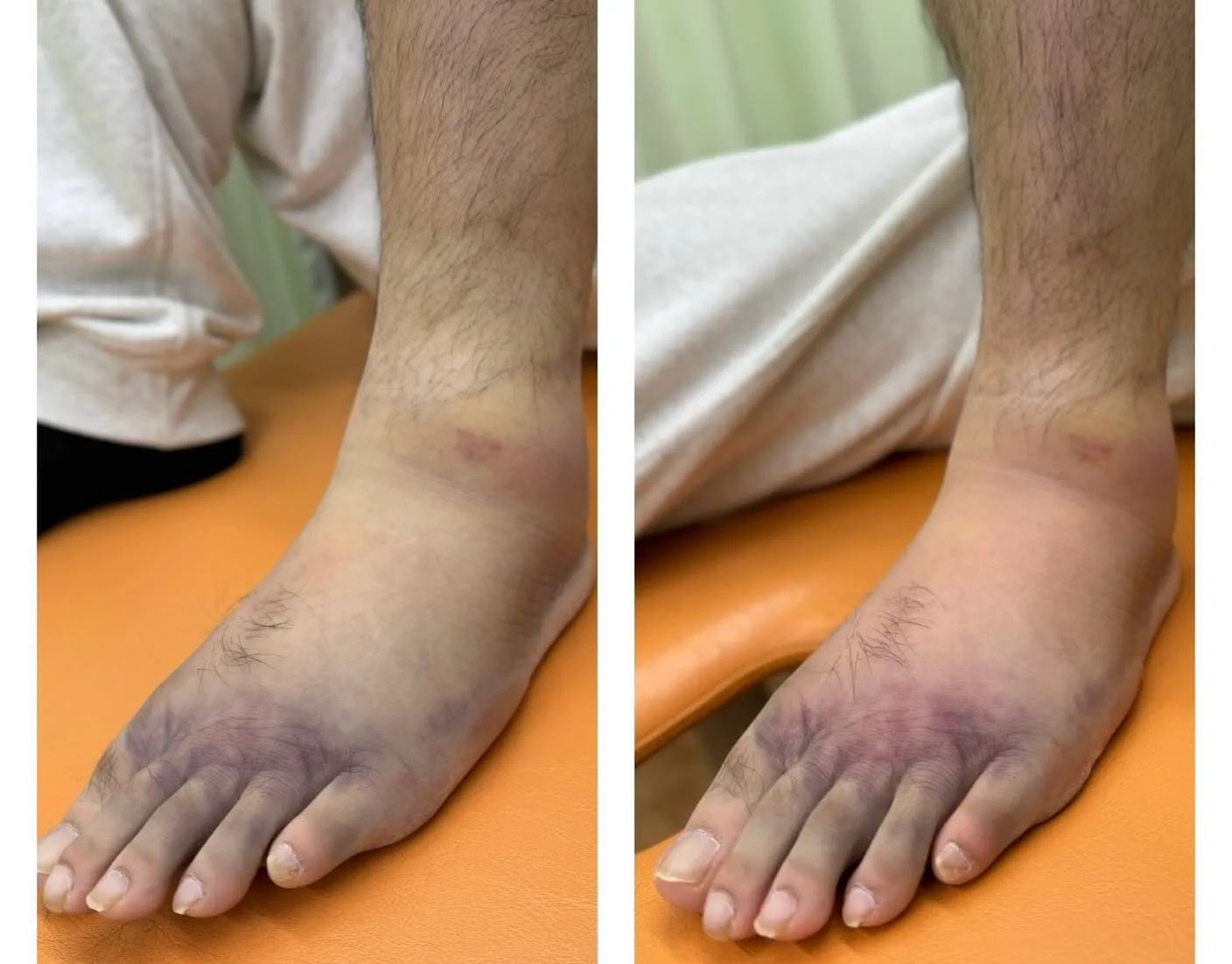 スポーツのケガ、